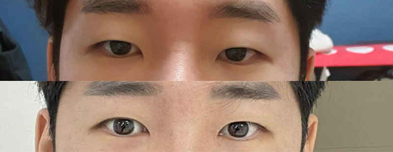 눈매교정(부분절개), 앞트임