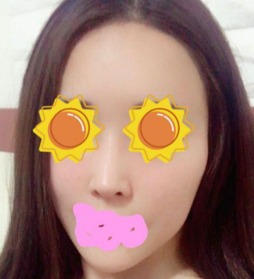 광대축소술 1년반 후기에요!