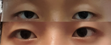 #비절개눈매교정