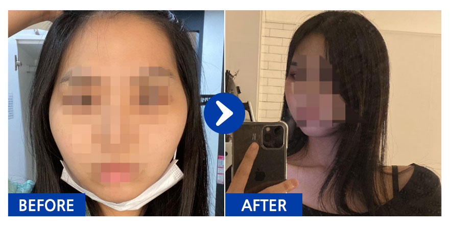 [바비톡] 안면윤곽 / 1개월차/ 닉네임: 다라뮈