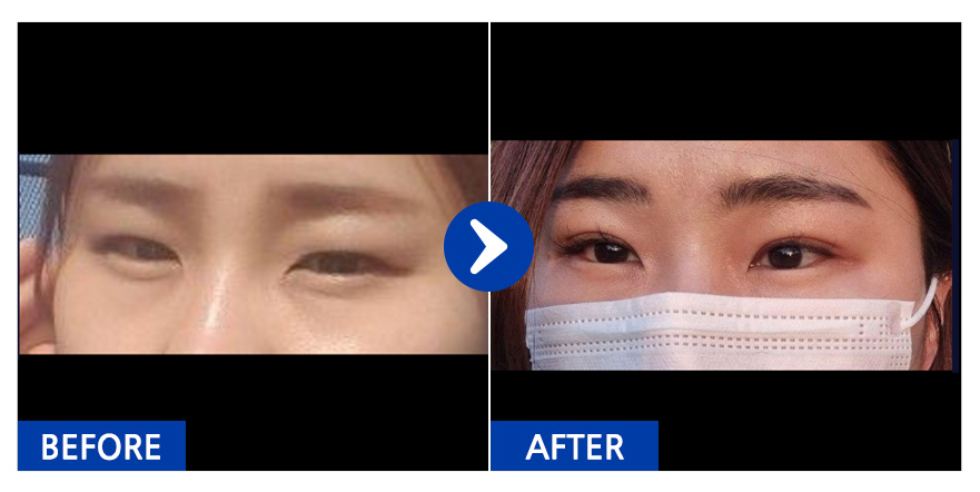 [바비톡] 쌍꺼풀/ 4개월차 / 닉네임 : 발랄걸