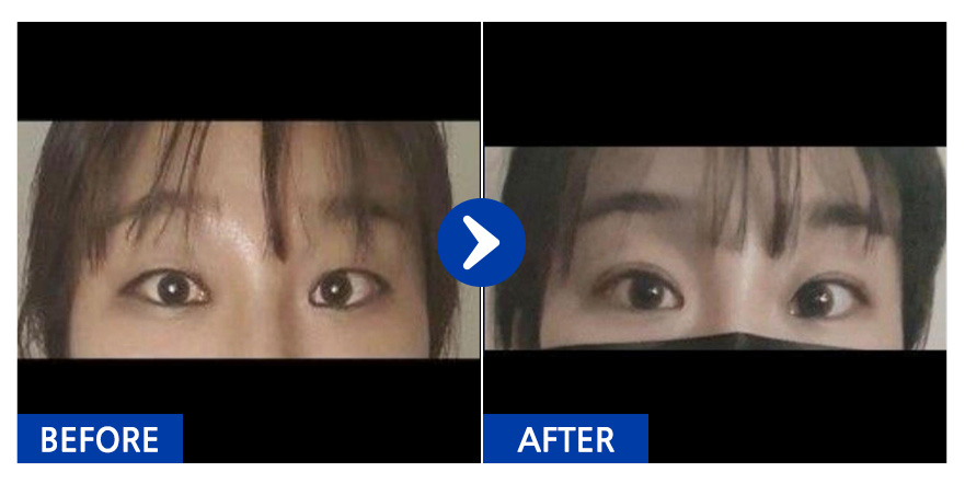 [바비톡] 쌍꺼풀 / 3개월차 / 닉네임 : tilia20