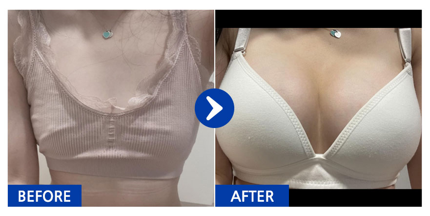 [바비톡] 가슴성형(세빈마텍) / 5개월차 / 닉네임:횬니횬니야