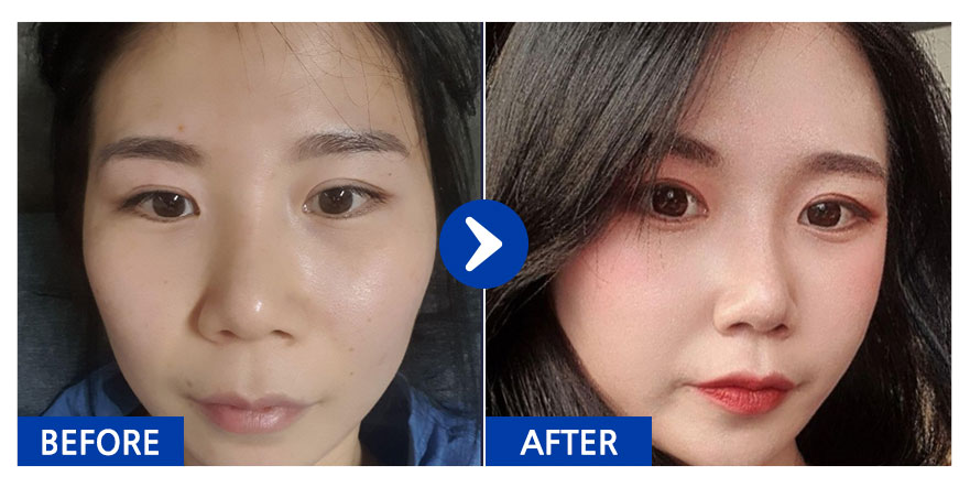 [바비톡] 코성형 / 2개월차 / 닉네임 : 닉넴11111