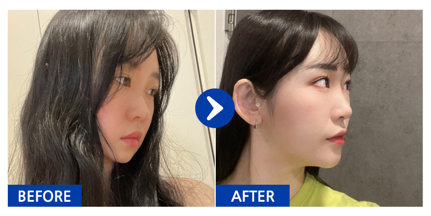 [바비톡] 코성형 / 6개월차 / 닉네임 : 횬니횬니야