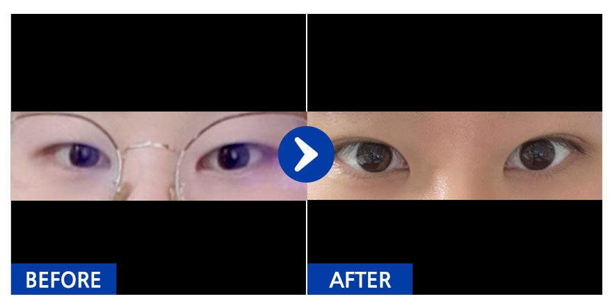 [강남언니] 쌍꺼풀(자연유착) / 닉네임 : juankim