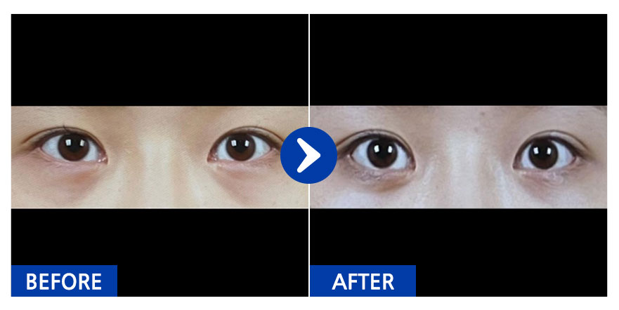 [바비톡] 듀얼트임, 눈지재 / 1개월차 / 닉네임:냐아아아에에용