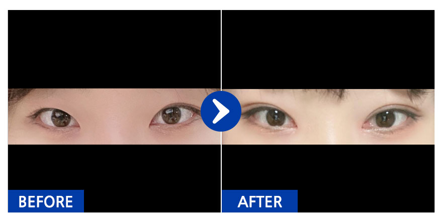 [강남언니] 자연유착(쌍꺼풀), 앞트임, 눈매교정 1개월차 / 닉네임 : 포하항푸하항