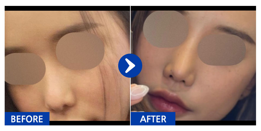 [강남언니] 코재수술 1개월차 / 닉네임: huisll_day