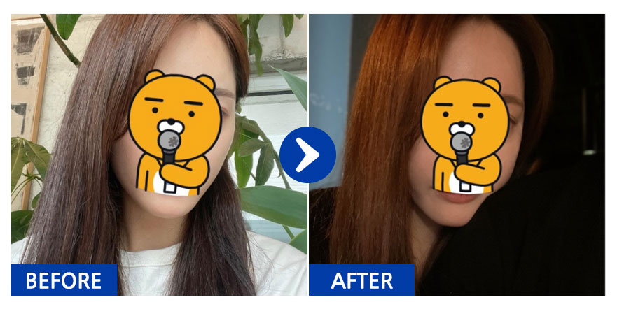 [강남언니] 광대 1개월차 / 닉네임 : 유후후후후ㅜ