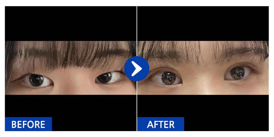 [강남언니] 쌍꺼풀(절개), 눈매교정 1개월차 / 닉네임 : 용쩌구