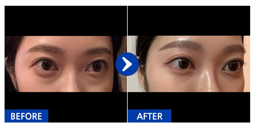 [강남언니] 눈밑지방재배치 1개월차_liina_