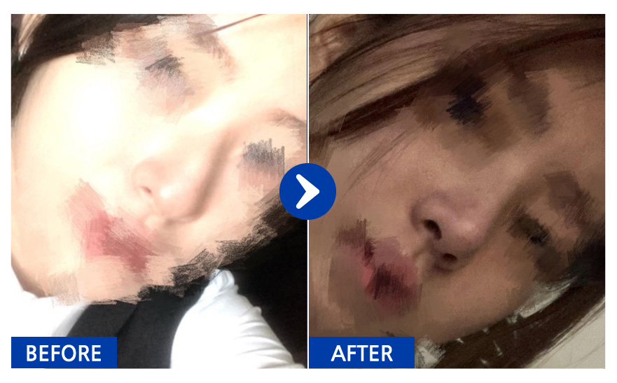 [바비톡] 코성형 1개월차/ 닉네임:냥이gRtzK