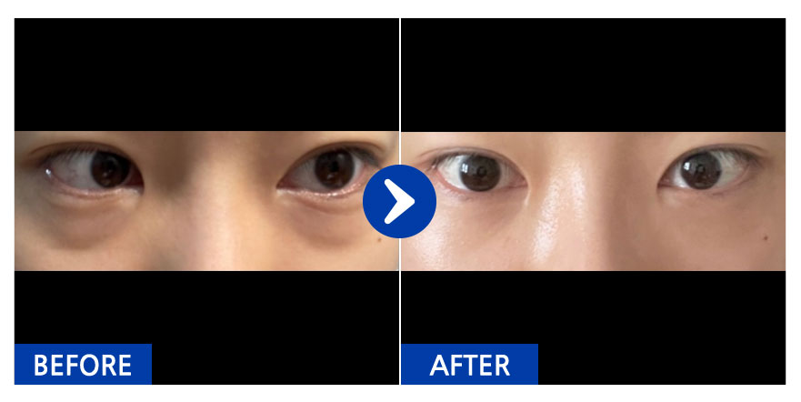 [강남언니] 눈밑지방재배치 / 1개월차 / 닉네임 : castle030