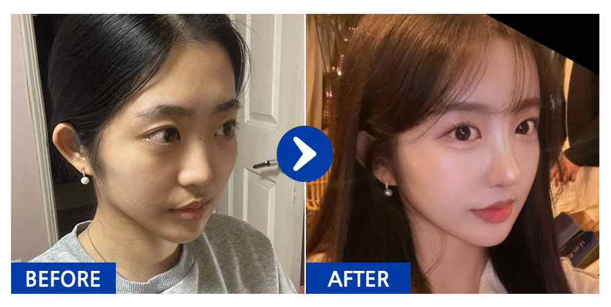 [강남언니 후기] 코성형, 이마지방이식 / 1주차 / 닉네임:냥냥냥웅웅