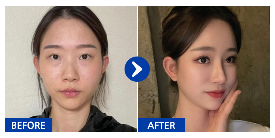 [바비톡 후기] 눈재수술,코,가슴(모티바),지방이식(이마앞광대),윤곽2종 / 6개월차 / 닉네임:듀듀듀쥬쥬