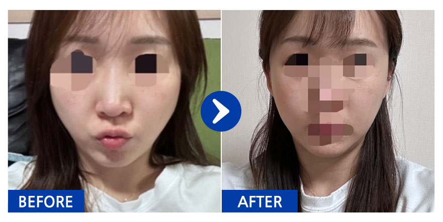 [강남언니] 광대 / 1개월차 / 닉네임 : 찌니이에옹