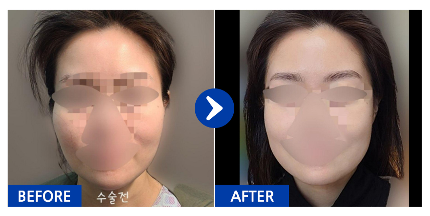 [바비톡] 윤곽2종(광대, 사각턱) / 1개월차 / 닉네임:토끼65Nsj