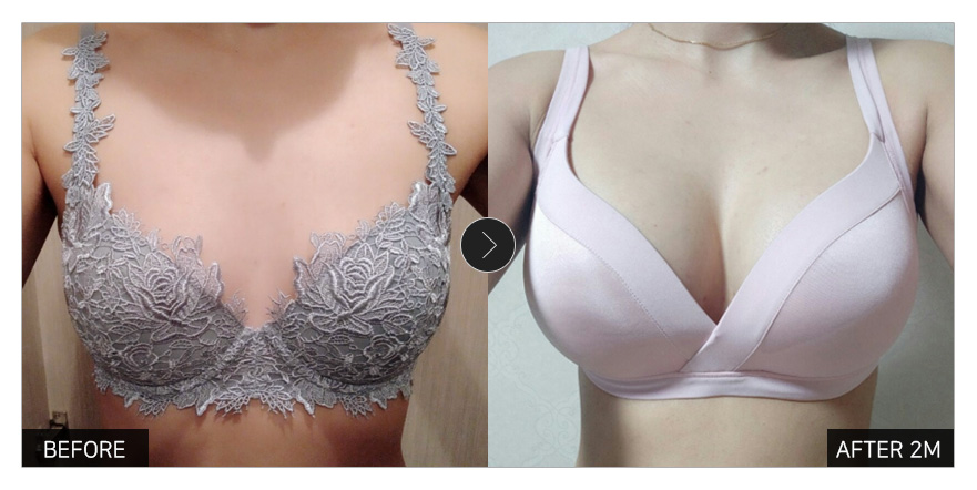 [강남언니 후기] 가슴성형 2개월차 / 닉네임 : 비띵