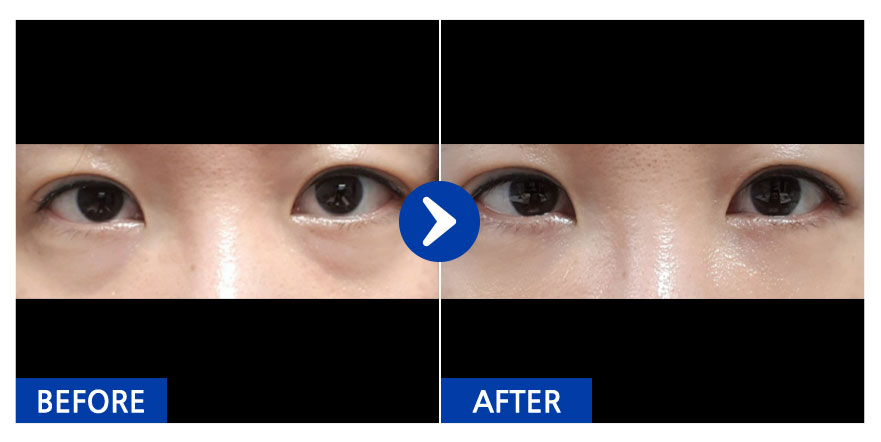 [강남언니] 눈밑지방재배치 / 1개월차 / 닉네임 : 나에요ㄴ