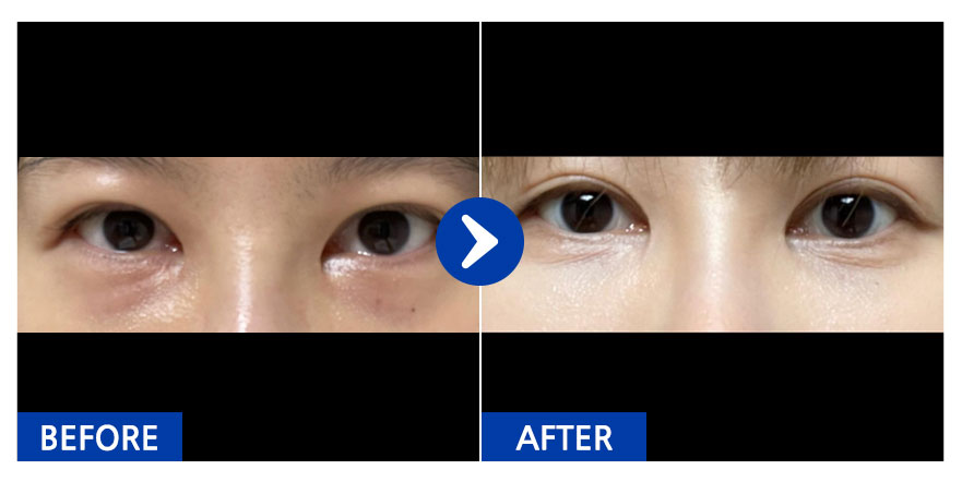 [강남언니] 눈밑지방재배치 / 1개월차 / 닉네임: anjjjjjjj