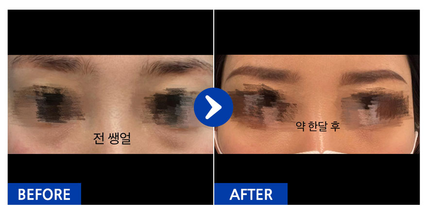 [강남언니] 눈밑지방재배치 / 1개월차 / 닉네임: 쑈롱