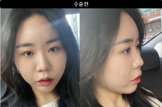 [강남언니 후기] 코성형 1개월차 / 닉네임 : 드르르륵드르륵