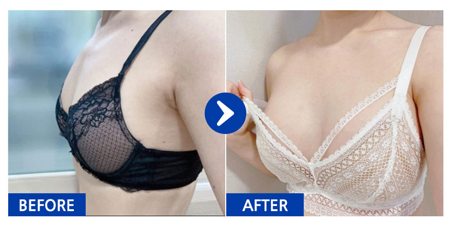 [강남언니] 가슴성형(세빈서브) / 1개월차/ 닉네임:째유유