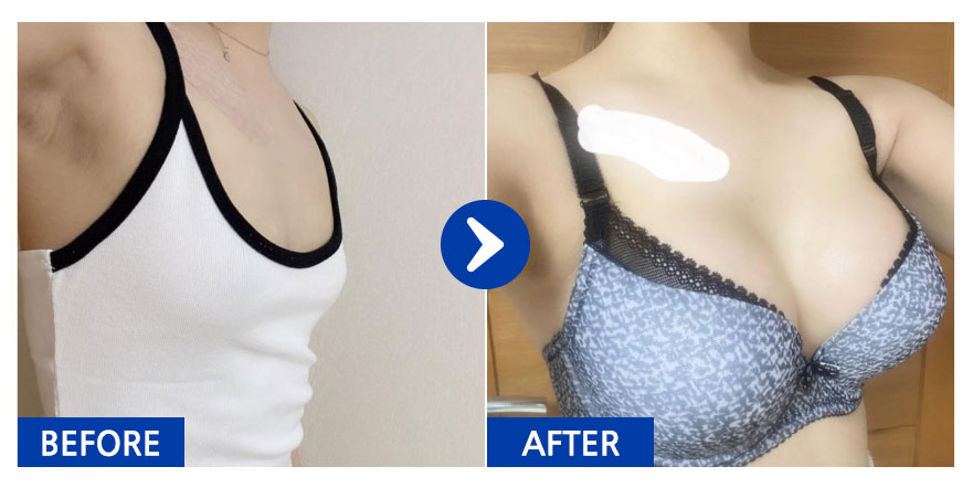 [강남언니] 가슴성형(멘토) / 4개월차/ 닉네임:푸항하하