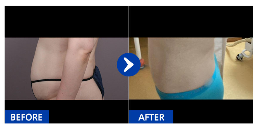 [바비톡] 지방흡입 / 1개월차/ 닉네임:꽃다운그자