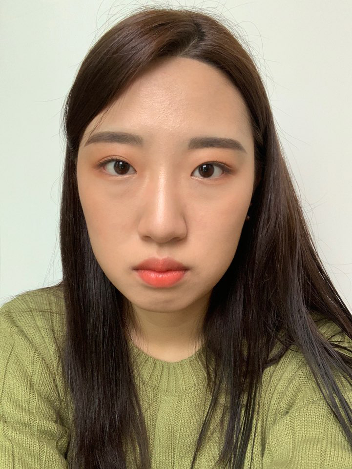 [눈] 샤랄라 - 비절개눈매교정, 앞트임, 눈밑지방재배치