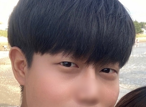 [남자] 유강 - 절개눈매교정