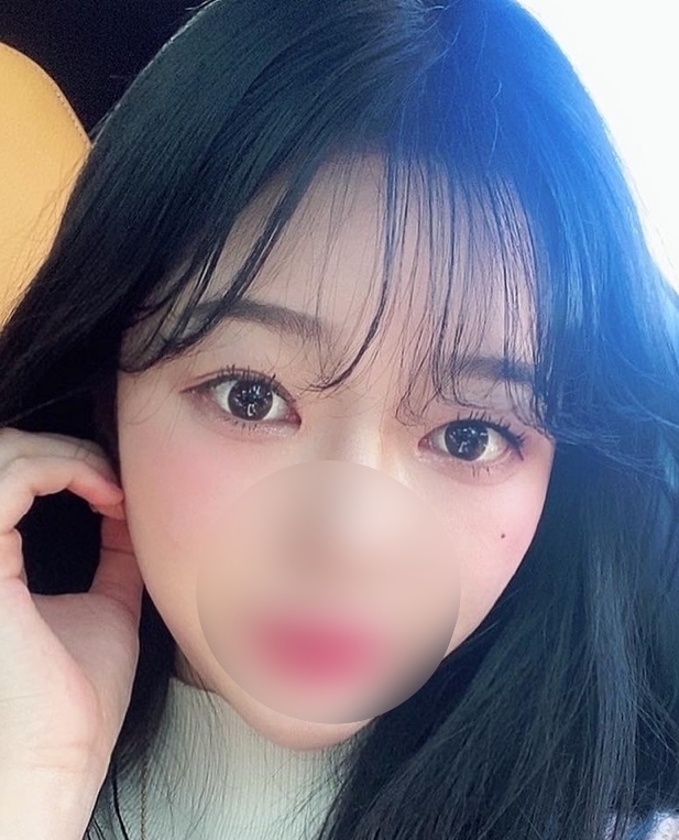 [눈] 뽀모도로 - 절개쌍꺼풀(재수술)