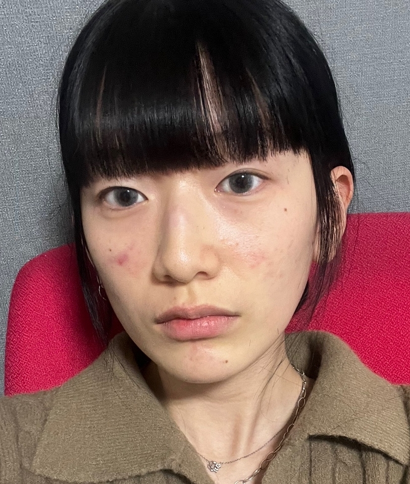 [눈] 이슬 - 비절개눈매교정