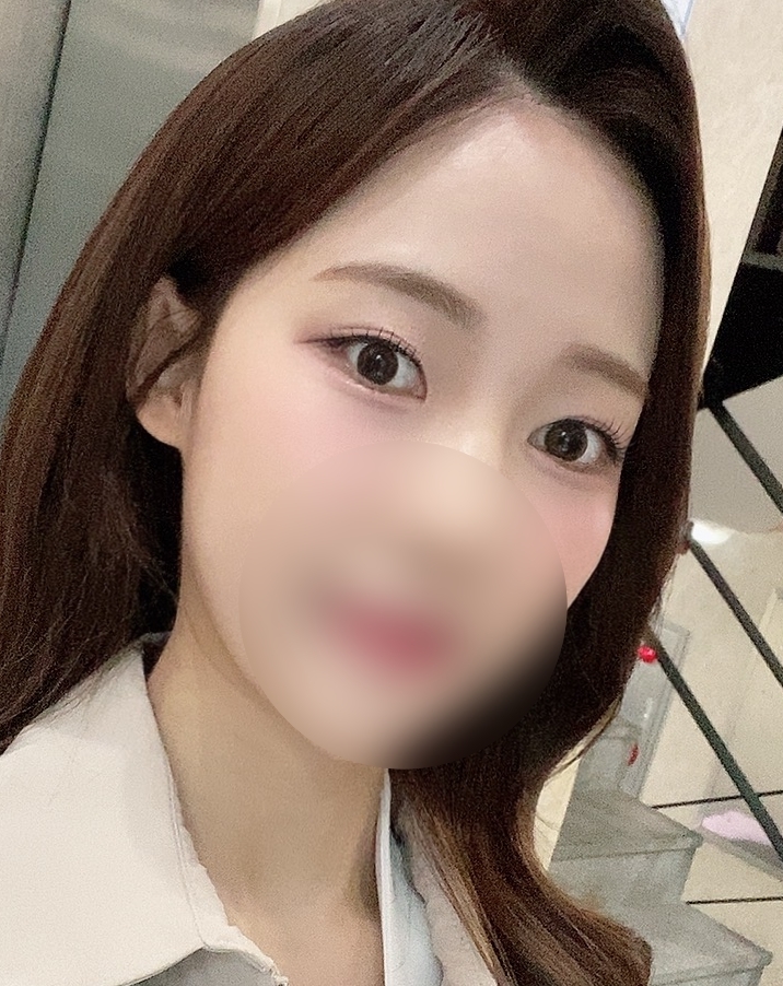 [눈] 짜냥 - 매몰쌍꺼풀(재수술)