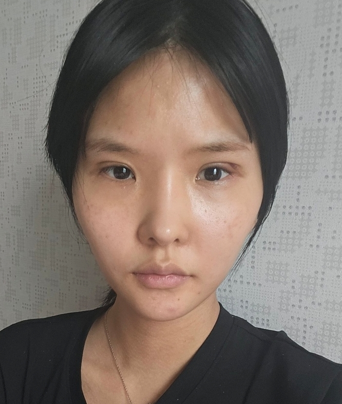 [눈] 민초단 - 절개눈매교정,앞트임,뒤트임,밑트임 재수술