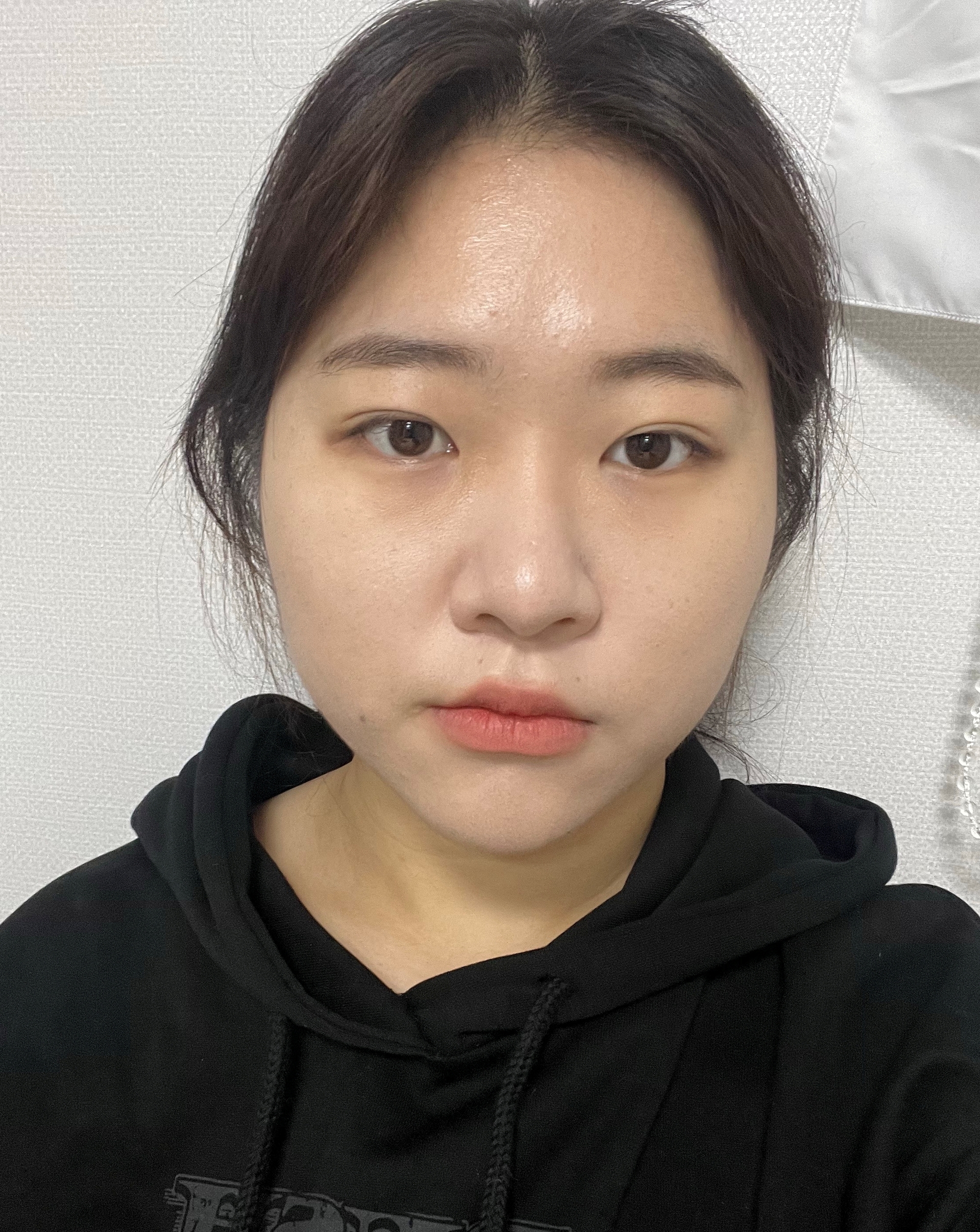 [눈] 체리젤리 - 뒤트임, 밑트임