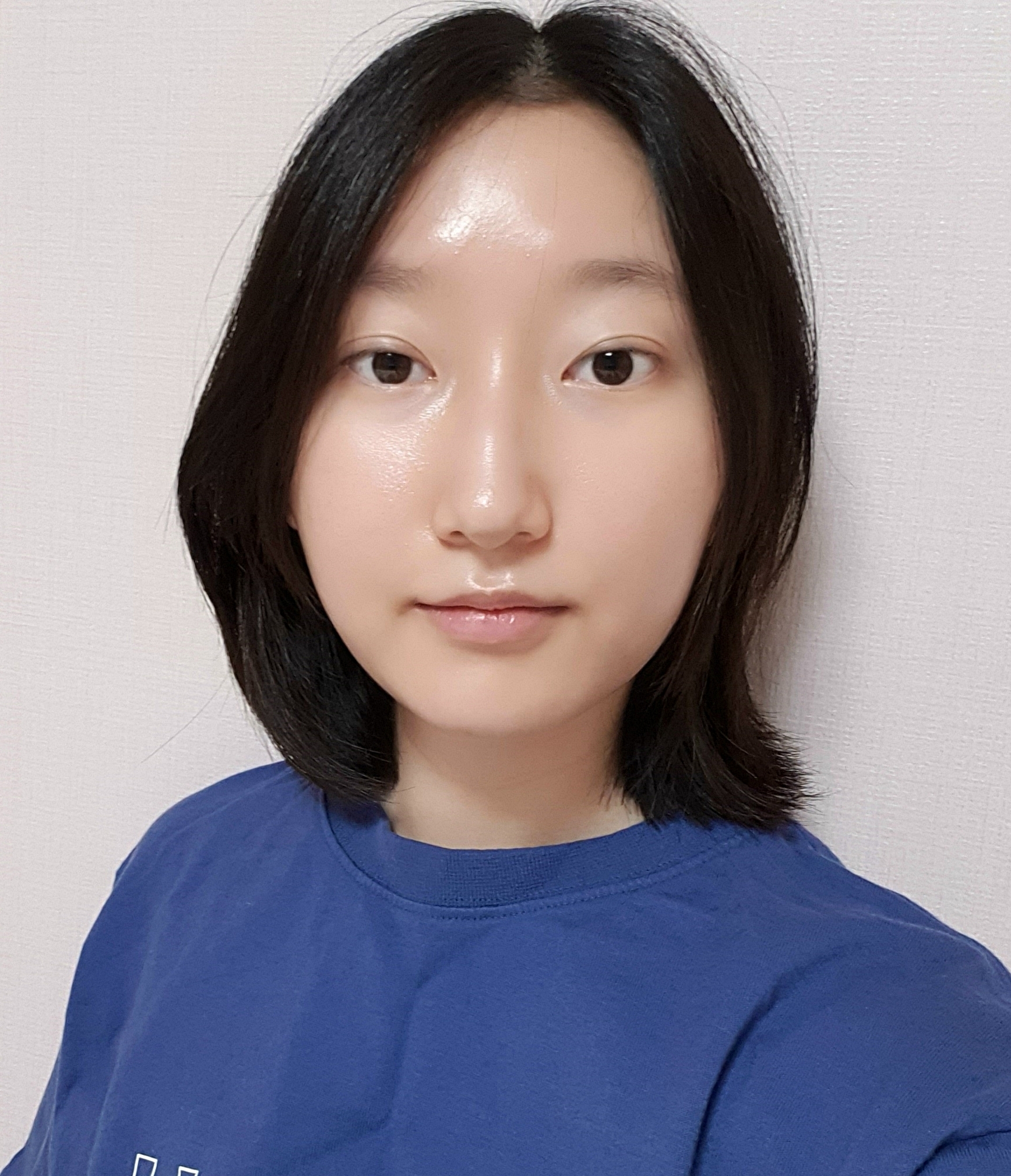 [눈] 계란말이 - 절개 눈매교정 재수술, 밑트임