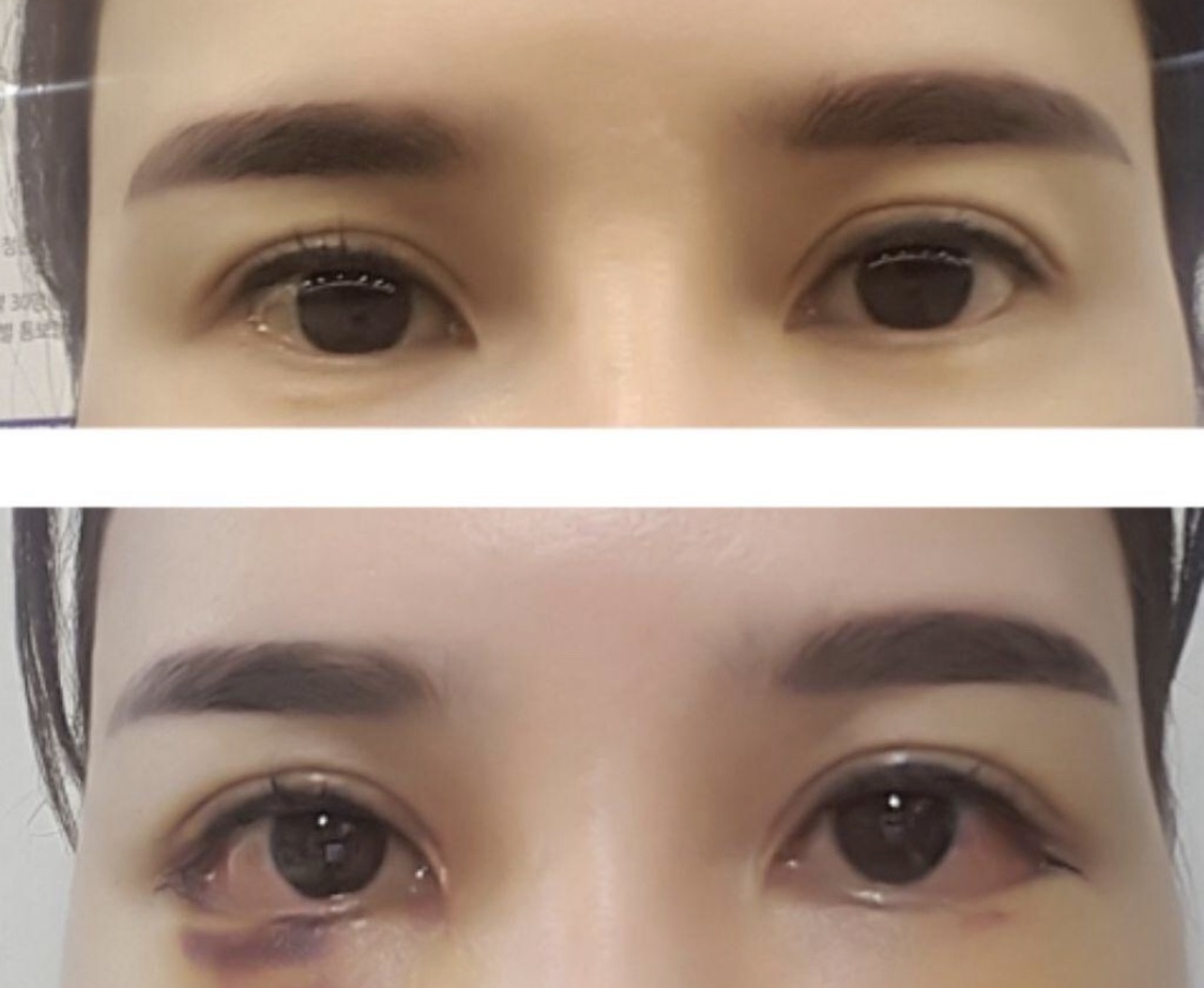 [눈] 상크미걸 - 밑트임,뒤트임