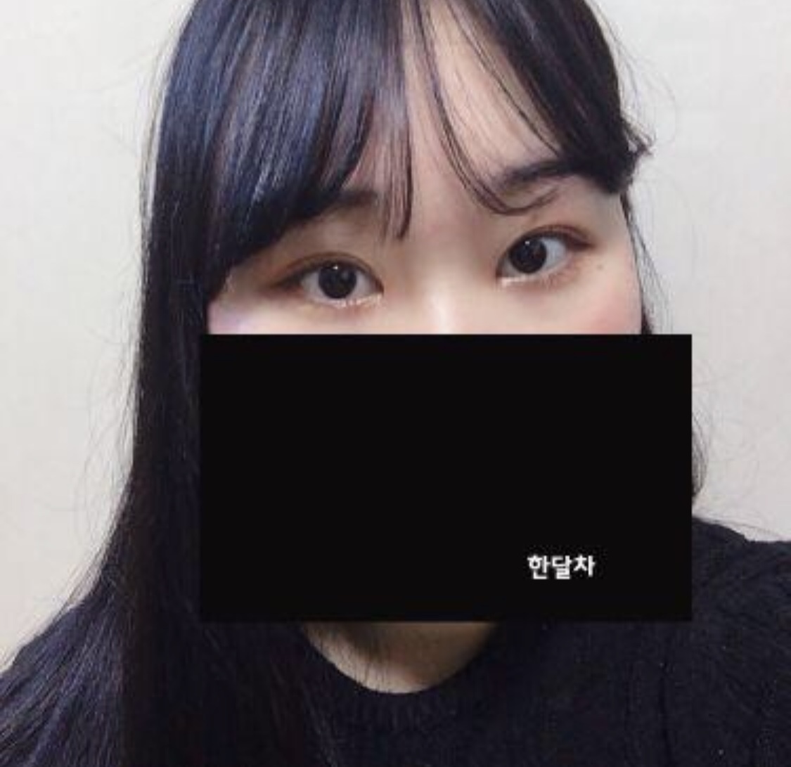 [눈] wwqwr_1234 - 앞트임, 매몰