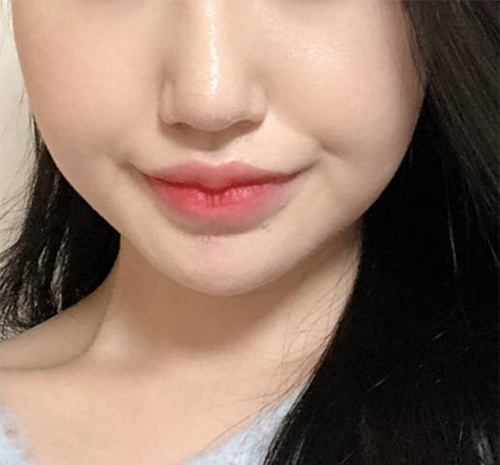 [피부] 지짖지지지지 - 슈링크,윤곽톡신