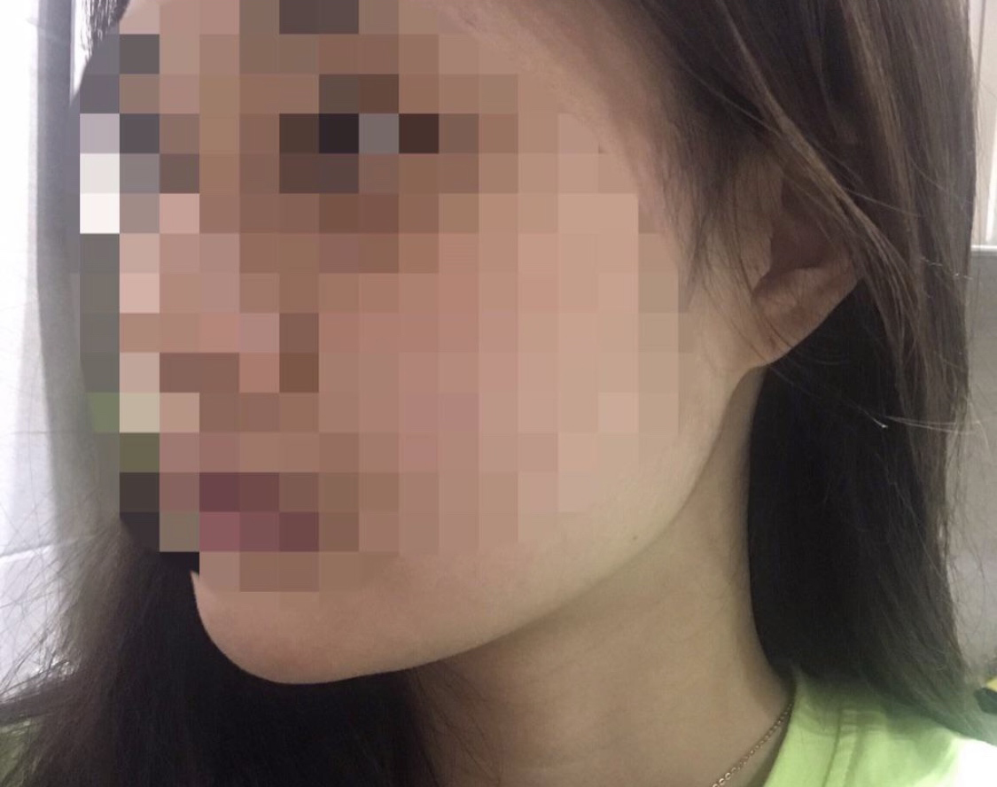 [쁘띠] 니나낭이잉 - 지방분해주사,리프팅