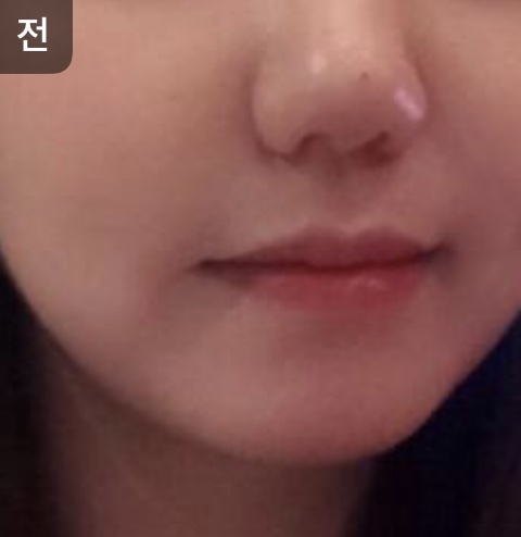 [피부] oy1004 - 리프팅,물광주사