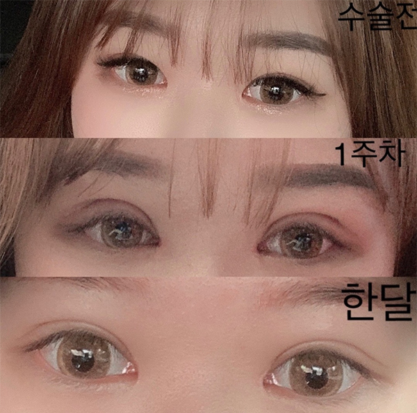 [눈] 로시온 - 윗트임, 눈매교정, 재수술