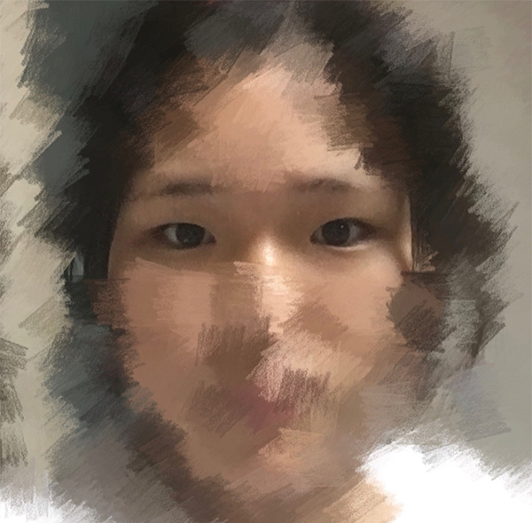 [눈] 정예슬 - 앞트임, 눈매교정