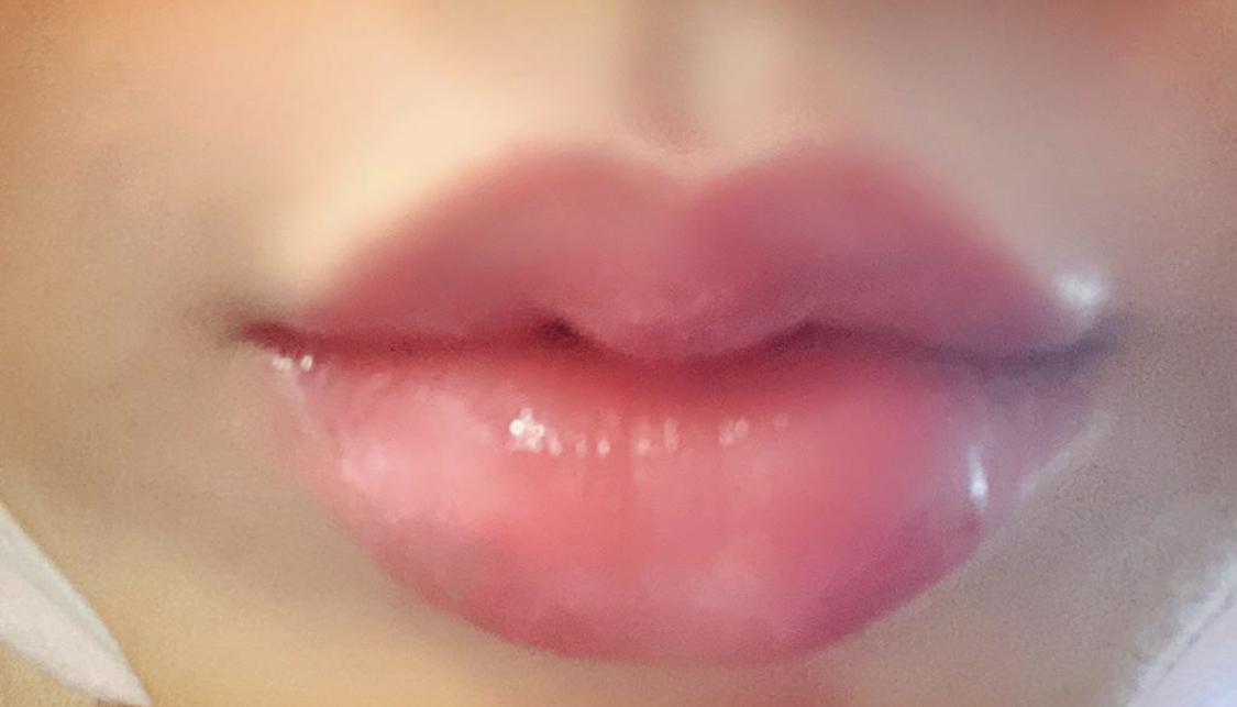 [쁘띠] 정든2 - 입술필러