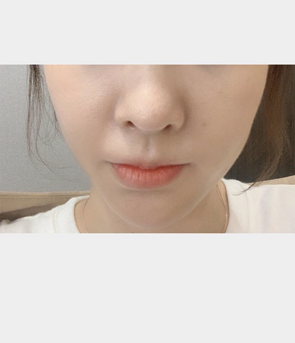 [쁘띠] 55정이 - 실리프팅