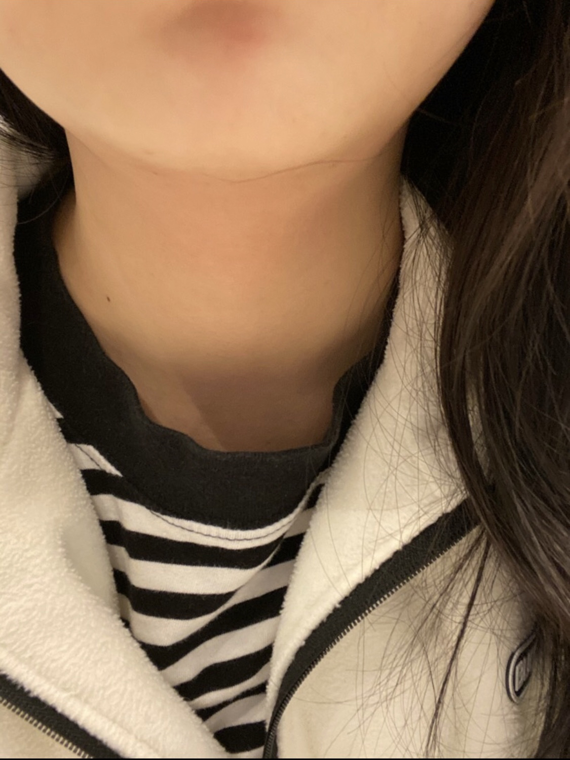 [쁘띠] 턱주 - 슈링크리프팅