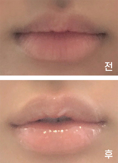 [쁘띠] ㅎ링ㅇ - 입꼬리,입술필러