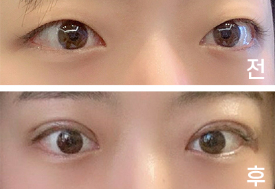 [눈] 지붕s2 - 윗트임,눈매교정